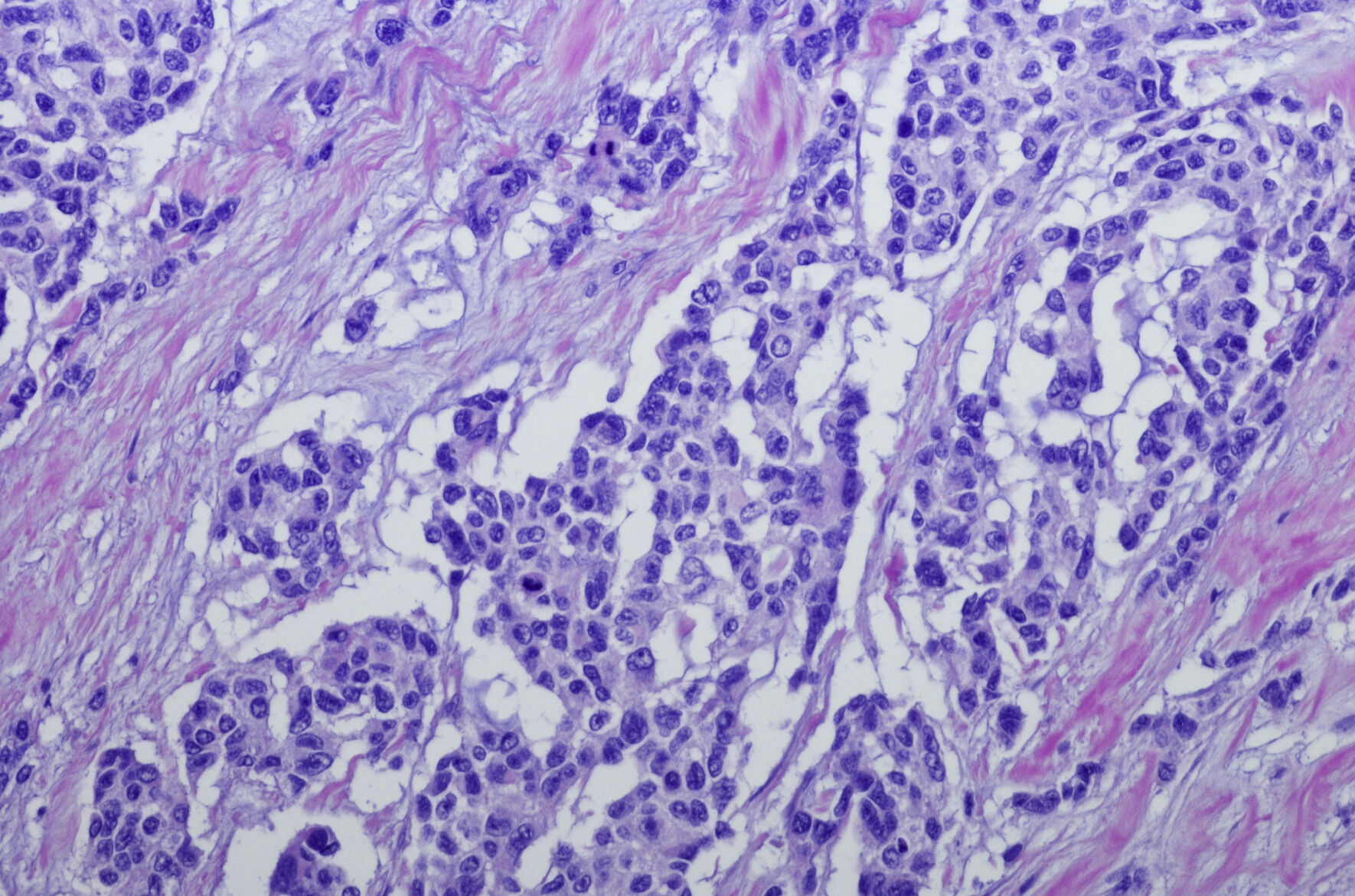 Micrograph of Rhabdomyosarcoma (RMS)